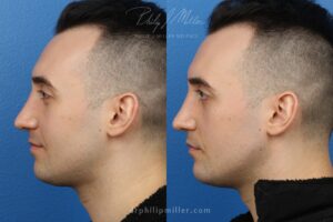 cosmetic treatment before and after results on male patient from NY, NY