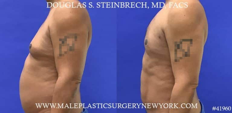 Gynecomastia treatment to shape the male chest contour by Dr. Steinbrech