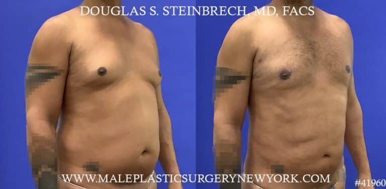 Gynecomastia treatment to shape the male chest contour by Dr. Steinbrech