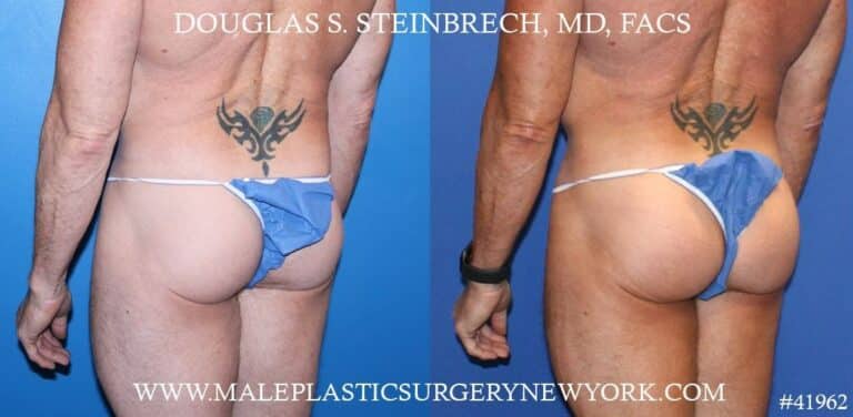 Gluteal implants to augment the buttocks by Dr. Steinbrech