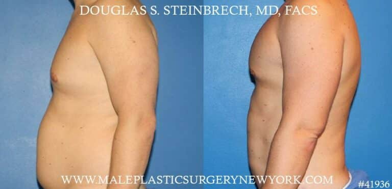 Gynecomastia treatment and pec contouring by Dr. Steinbrech