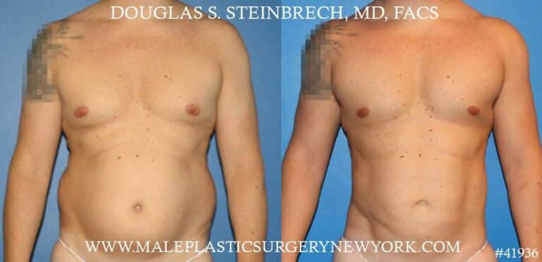 Gynecomastia treatment and pec contouring by Dr. Steinbrech