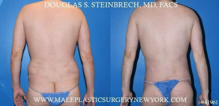 Torso Tuck with Body Banking to Pecs and Glutes by Dr. Steinbrech