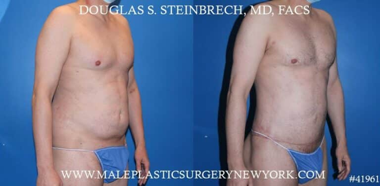 Torso Tuck with Body Banking to Pecs and Glutes by Dr. Steinbrech