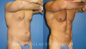 body banking before and after results in NYC, NY