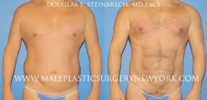 body banking body contouring before and after results in New York City