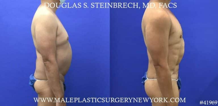 360 torso tuck with body banking to pecs, glutes, and shoulders by Dr. Steinbrech