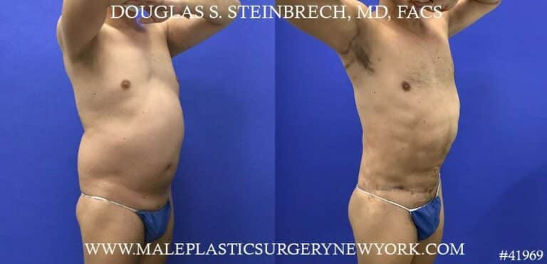 360 torso tuck with body banking to pecs, glutes, and shoulders by Dr. Steinbrech