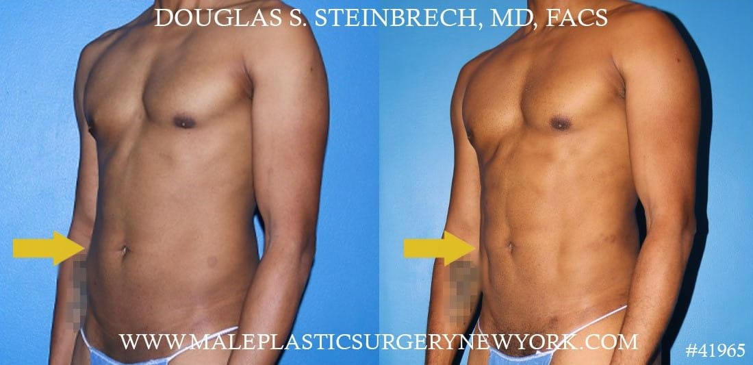 The Best Options for Male Body Contouring - Miami Plastic Surgeon