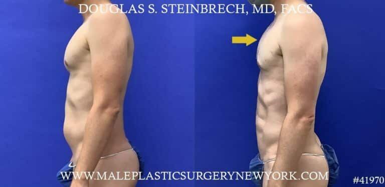 Liposuction with body banking to enhance the pecs by Dr. Steinbrech