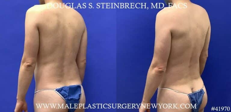 Liposuction with body banking to enhance the pecs by Dr. Steinbrech