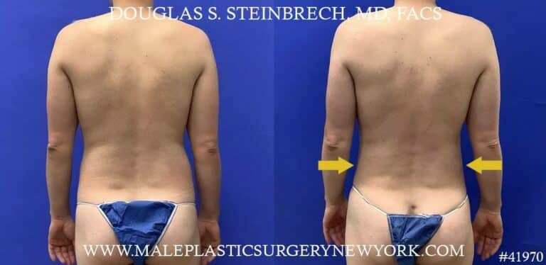 Liposuction with body banking to enhance the pecs by Dr. Steinbrech