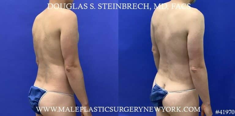 Liposuction with body banking to enhance the pecs by Dr. Steinbrech