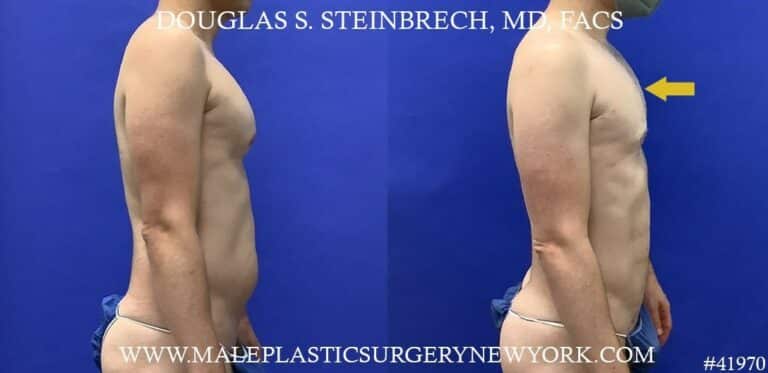 Liposuction with body banking to enhance the pecs by Dr. Steinbrech