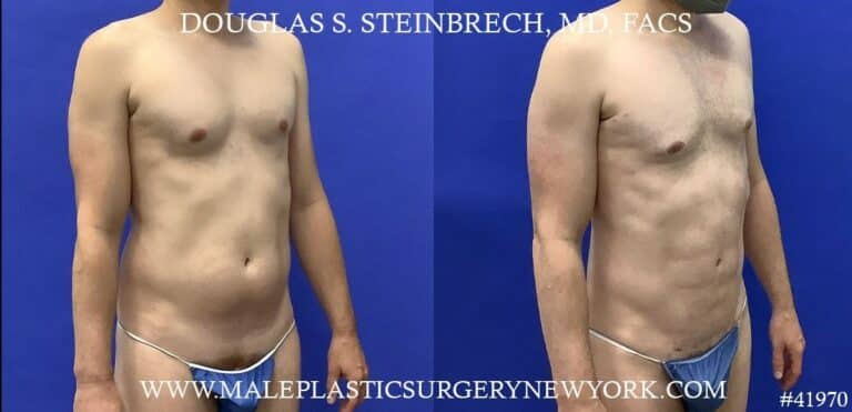 Liposuction with body banking to enhance the pecs by Dr. Steinbrech