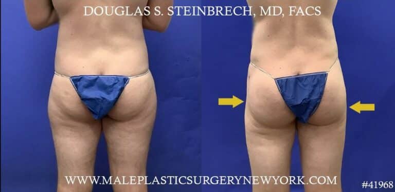 Body banking to masculinize hips by Dr. Steinbrech