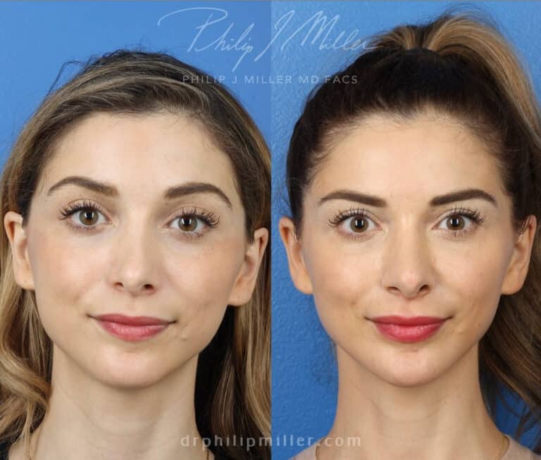 Revision rhinoplasty with chin implant to improve facial profile by Dr. Miller