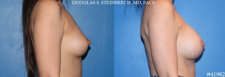 Breast augmentation using silicone implants by Dr. Steinbrech