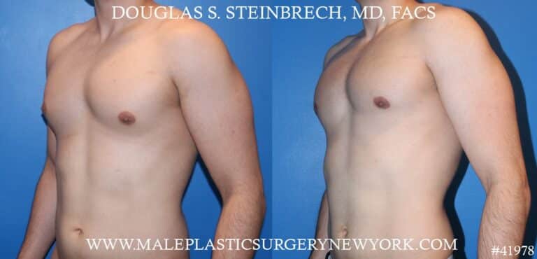 Gynecomastia treatment to enhance the contour of the male chest by Dr. Steinbrech