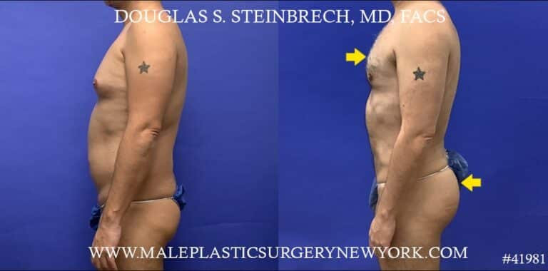 Liposuction with body banking to pecs and glutes by Dr. Steinbrech