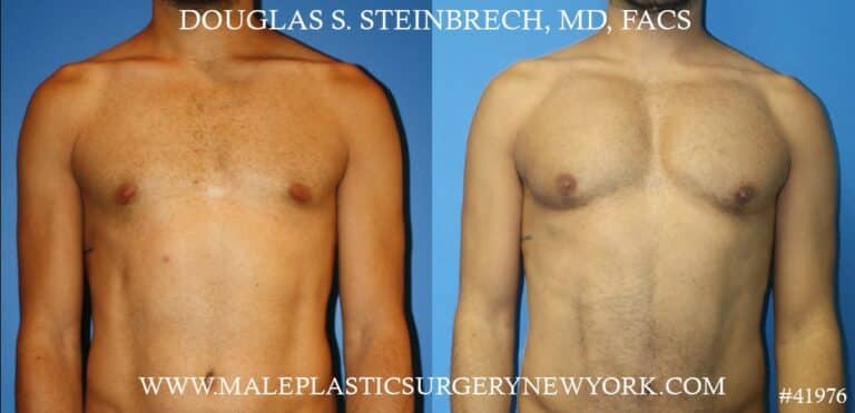 Pectoral implants to enhance the appearance of the male chest by Dr. Steinbrech