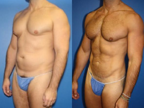 Bumps and lumps after abdominal lipo (2) : r/PlasticSurgery