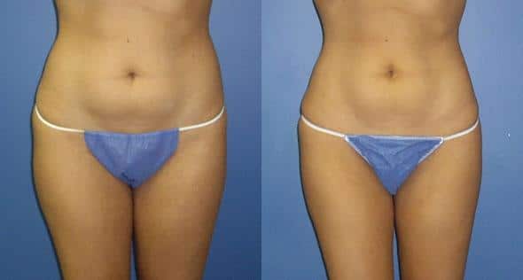 5 Way to Get rid of Lumps After Liposuction - Raadina Health