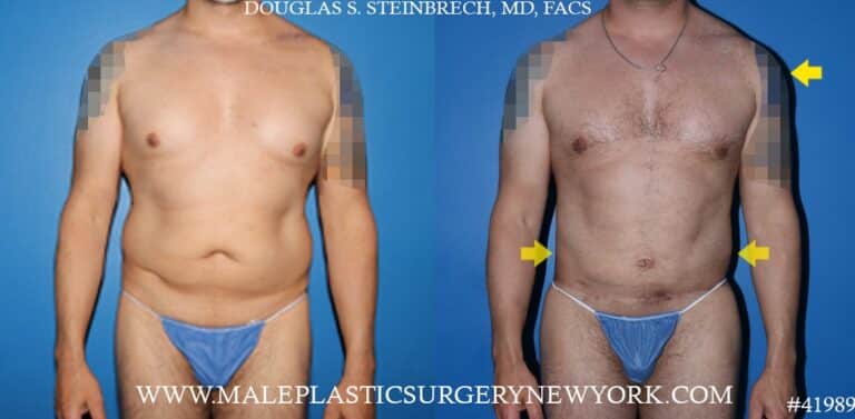 270° torso tuck with body banking to pecs, shoulders, and glutes by Dr. Steinbrech