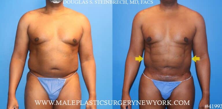 270° torso tuck with body banking to pecs, shoulders, traps, and glutes by Dr. Steinbrech