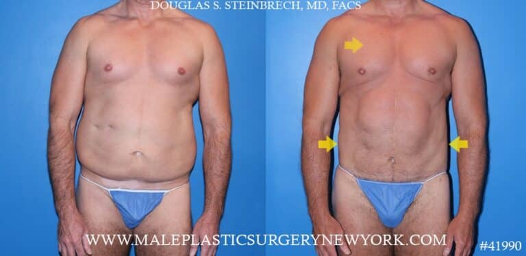 360° torso tuck with body banking to pecs and glutes by Dr. Steinbrech