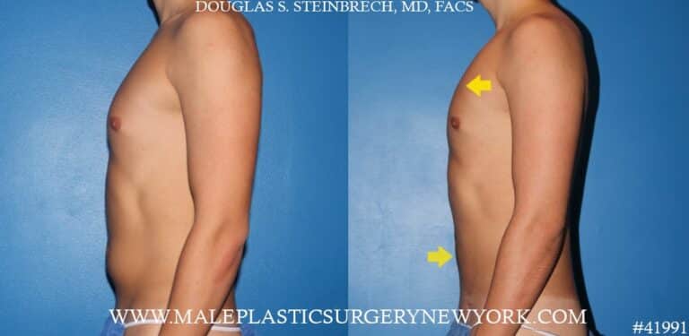 Gynecomastia treatment and liposuction with body banking to pecs by Dr. Steinbrech