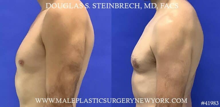 Liposuction and gynecomastia removal with body banking to pecs by Dr. Steinbrech