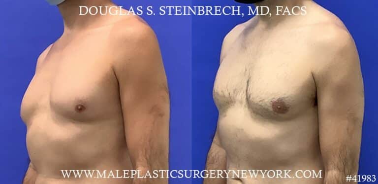 Liposuction and gynecomastia removal with body banking to pecs by Dr. Steinbrech