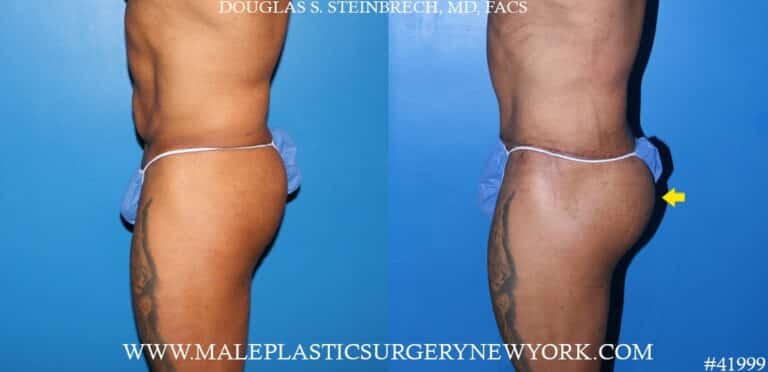 Composite gluteal augmentation with silicone implants and body banking by Dr. Steinbrech