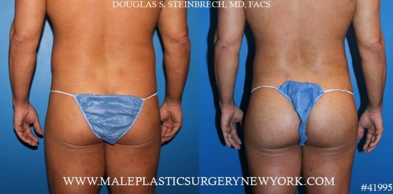 Gluteal augmentation using silicone implants by Dr. Steinbrech