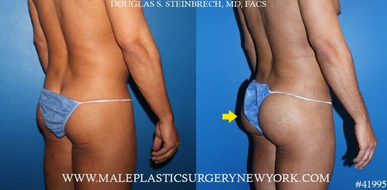 Gluteal augmentation using silicone implants by Dr. Steinbrech