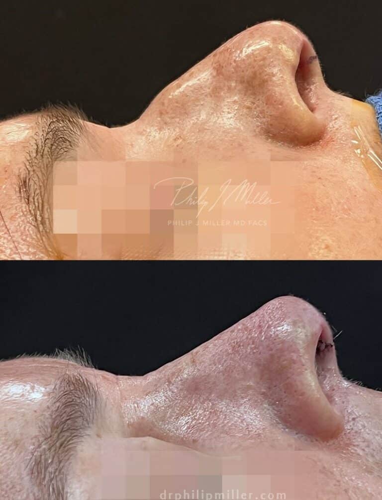 Rhinoplasty to improve patient profile by Dr. Miller