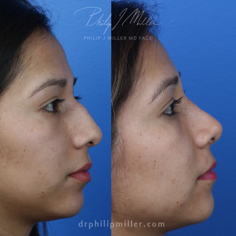 Rhinoplasty to Remove Hump on Nasal Bridge and Refine Tip by Dr. Miller