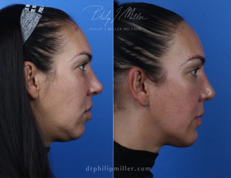 Rhinoplasty with chin implant to improve facial contour by Dr. Miller