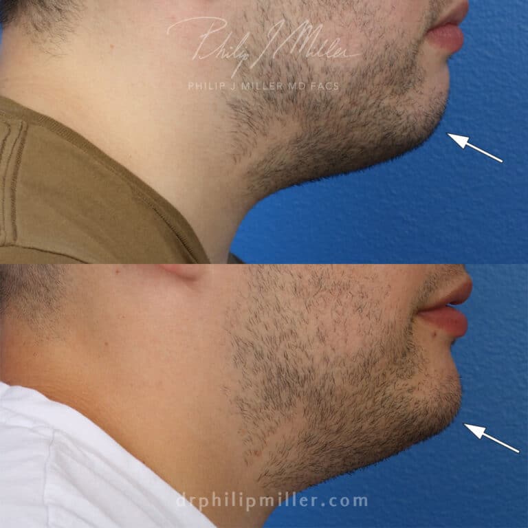 Chin implant to strengthen the jawline of a male patient by Dr. Miller