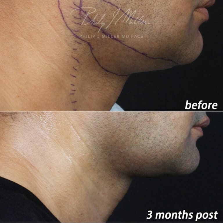My Ellevate for jawline contouring of a male patient by Dr. Miller