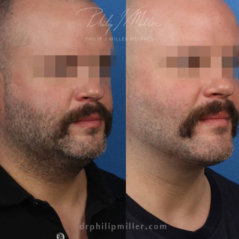 NeckTite to contour neck and jawline of male patient by Dr. Miller