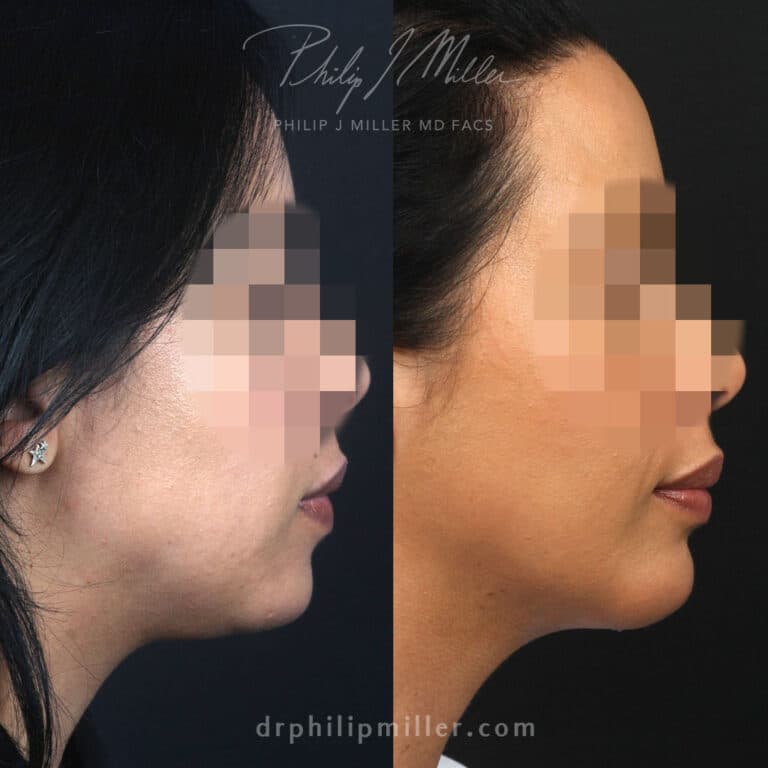 Chin implant, submental liposuction, and NeckTite to contour jawline by Dr. Miller