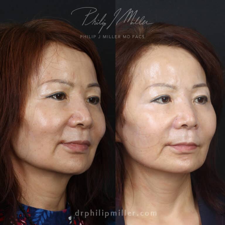Facelift to restore a youthful facial contour on a female patient by Dr. Miller