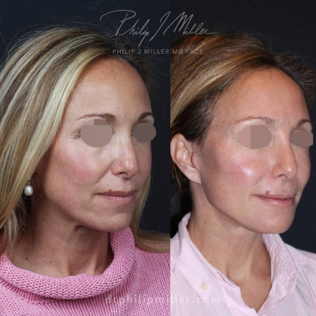 Facelift to define jawline and create a more youthful appearance for a female patient by Dr. Miller. After surgery, skin is firmer, jawline is sharper, and cheeks look more youthful.