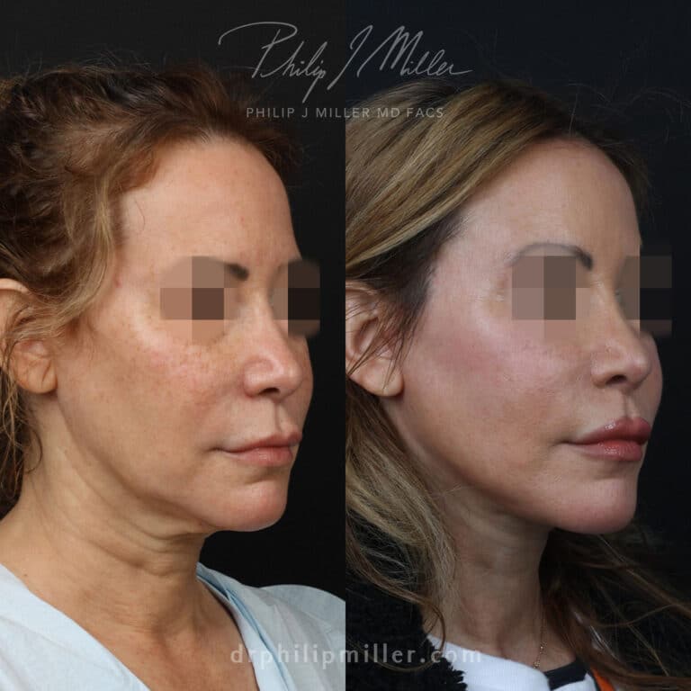 Facelift to rejuvenate the appearance of a female patient by Dr. Miller