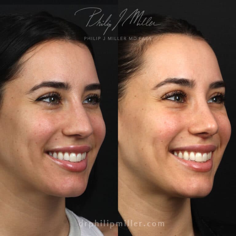Rhinoplasty and lip lift to improve profile of a female patient by Dr. Miller