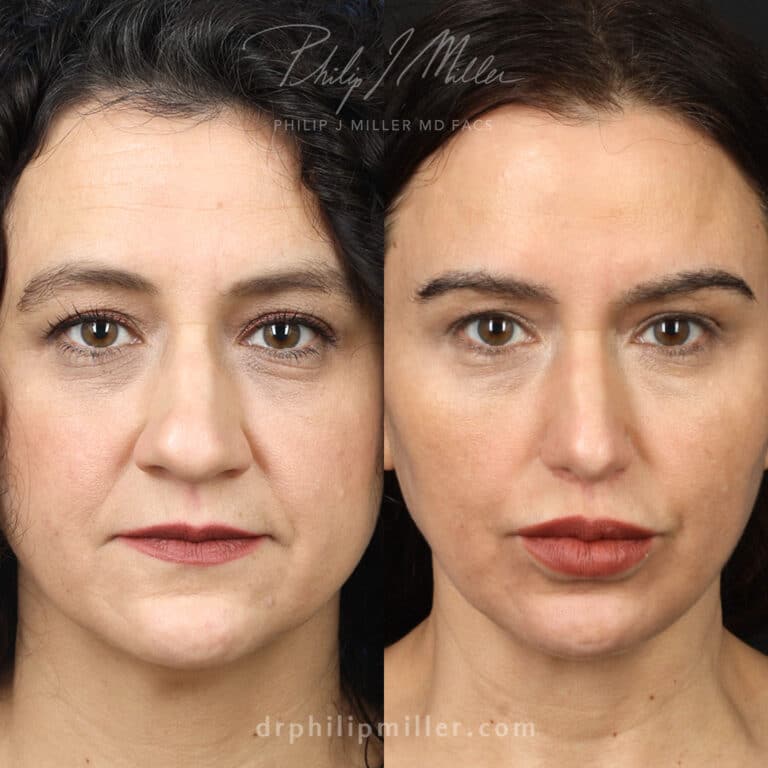 Rhinoplasty and facial fat grafting to enhance the facial contours of a female patient by Dr. Miller