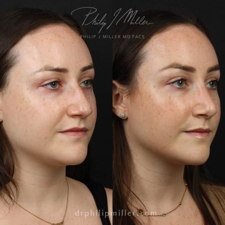Rhinoplasty to remove bump and straighten nasal bridge of female patient by Dr. Miller