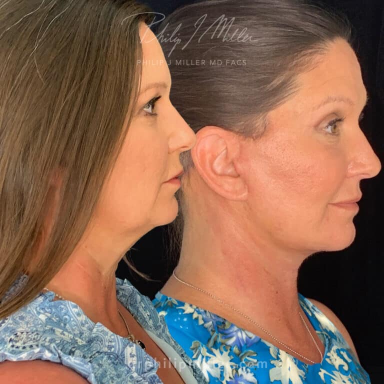 Facelift to rejuvenate the face and tighten jawline – 3 weeks post-op by Dr. Miller